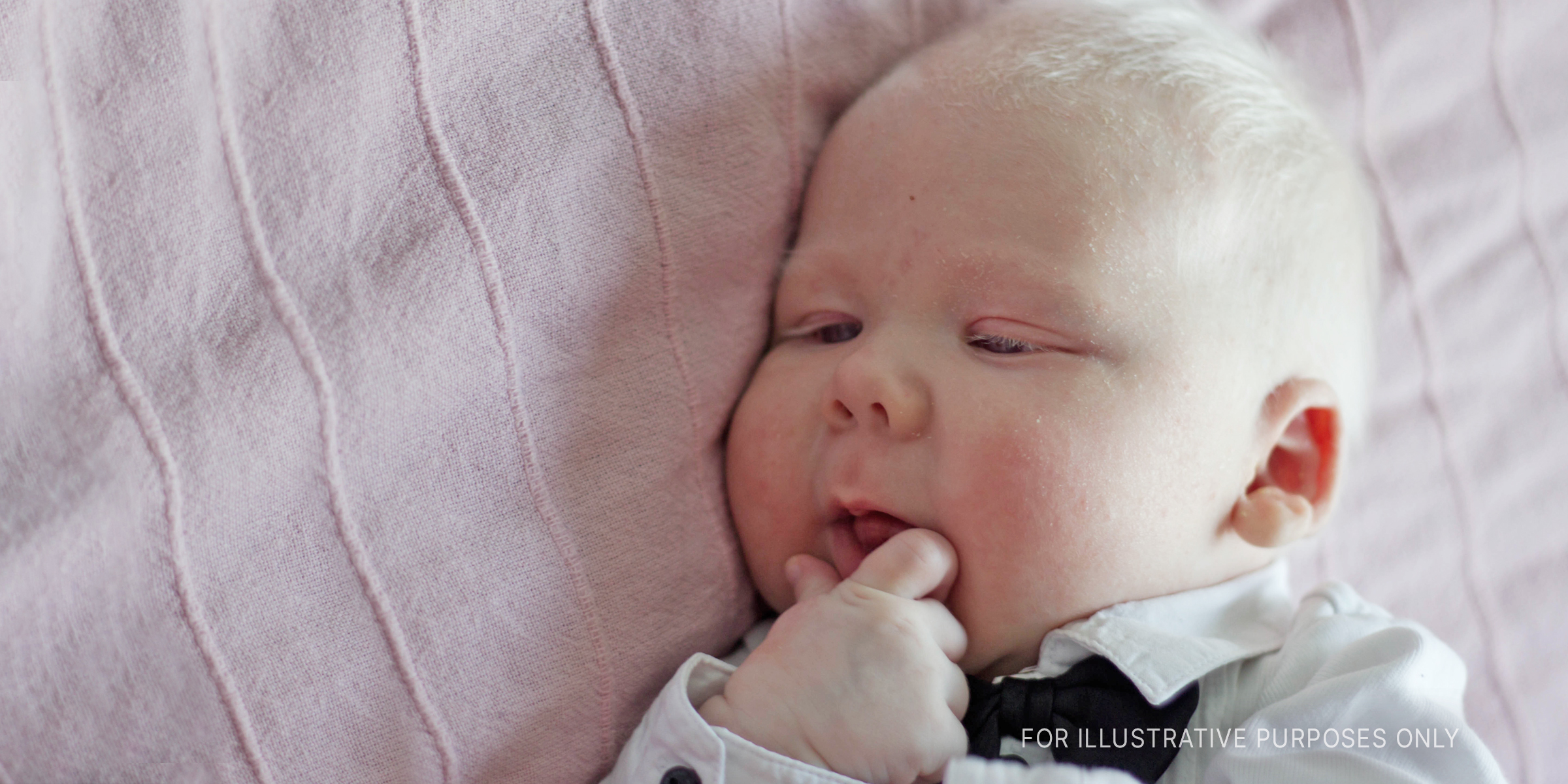 Baby with albinism lying on blanket | Source: Shutterstock